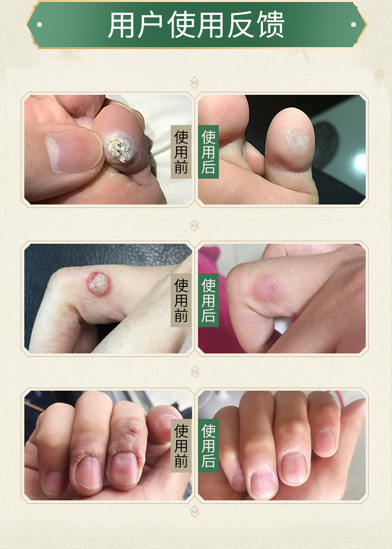 修正鸡眼膏祛足部手部老茧清茧膏子瘊刺肉疣寻常趾鸡眼贴丝状扁平贴清