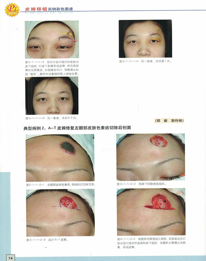 颜面部组织缺损与畸形的皮瓣修复第四章 颈部