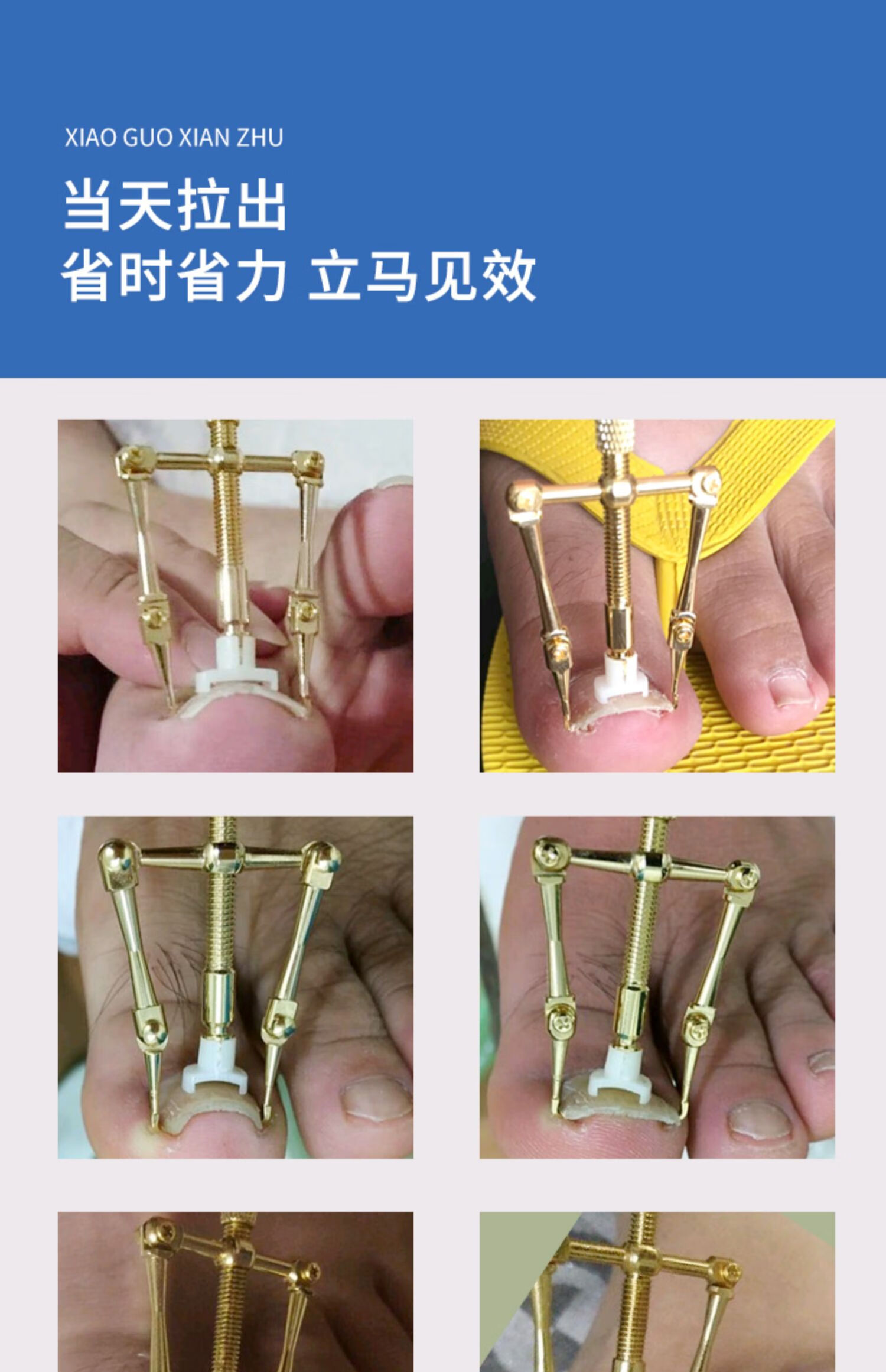 正甲贴片甲沟嵌甲矫正器脚趾甲指甲甲片往肉里长防止纠正炎非神器加强