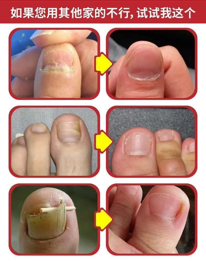 去灰指甲液发黑分离去除增厚灰甲脱甲膏喷剂专用液超大容量三盒装