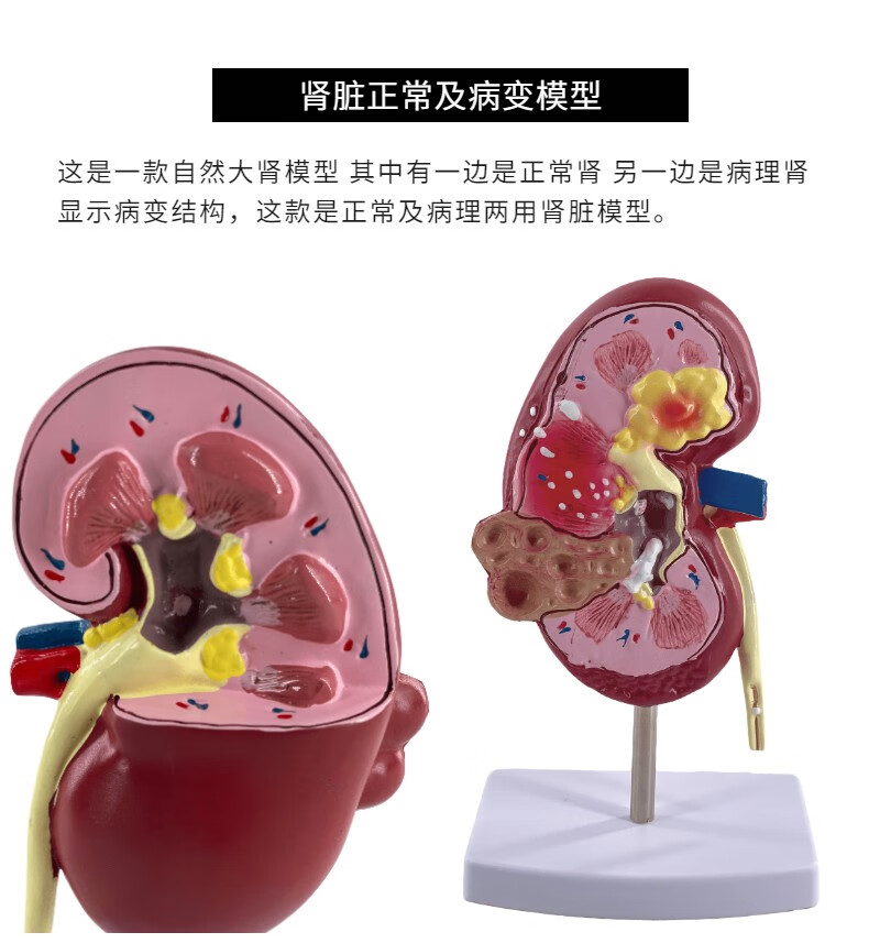 人体肾解剖模型病理肾脏模型2部件正常肾部模型专业内脏器官医学教具