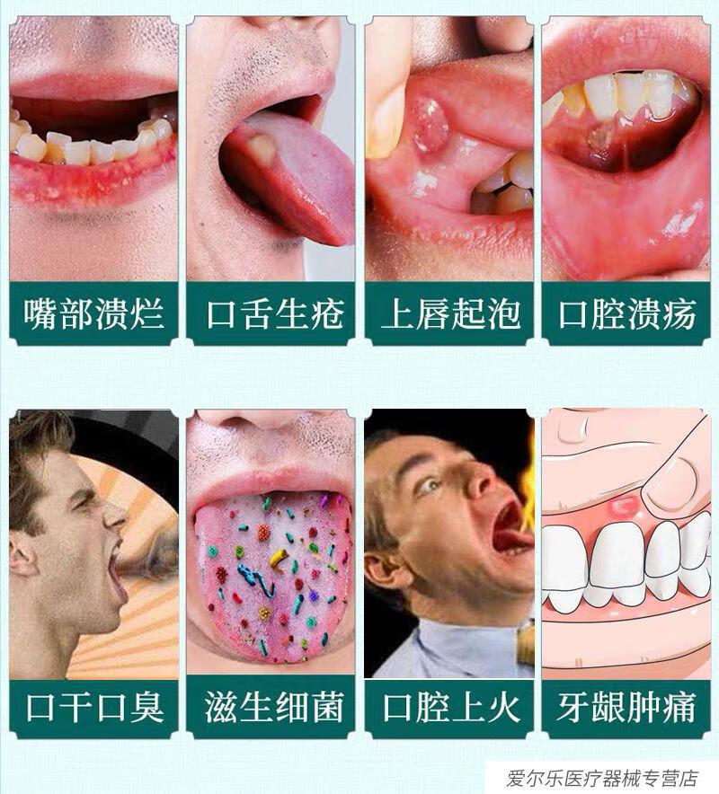 冰硼散口腔溃疡喷雾液喷剂一点灵复发性口疮凝胶儿童药水 两盒喷剂