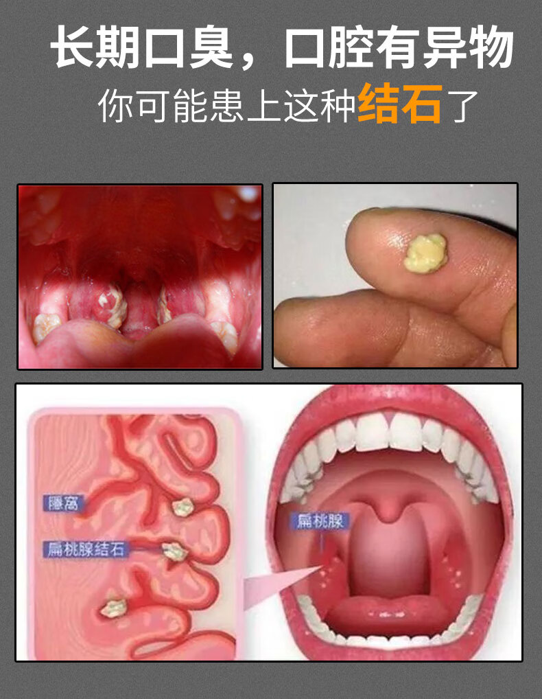 扁桃体隐窝凸起小肉芽图片