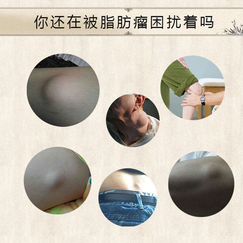 官方旗舰多发性脂肪瘤去除调理脂肪瘤消瘤膏去皮下脂肪瘤克星全身aa