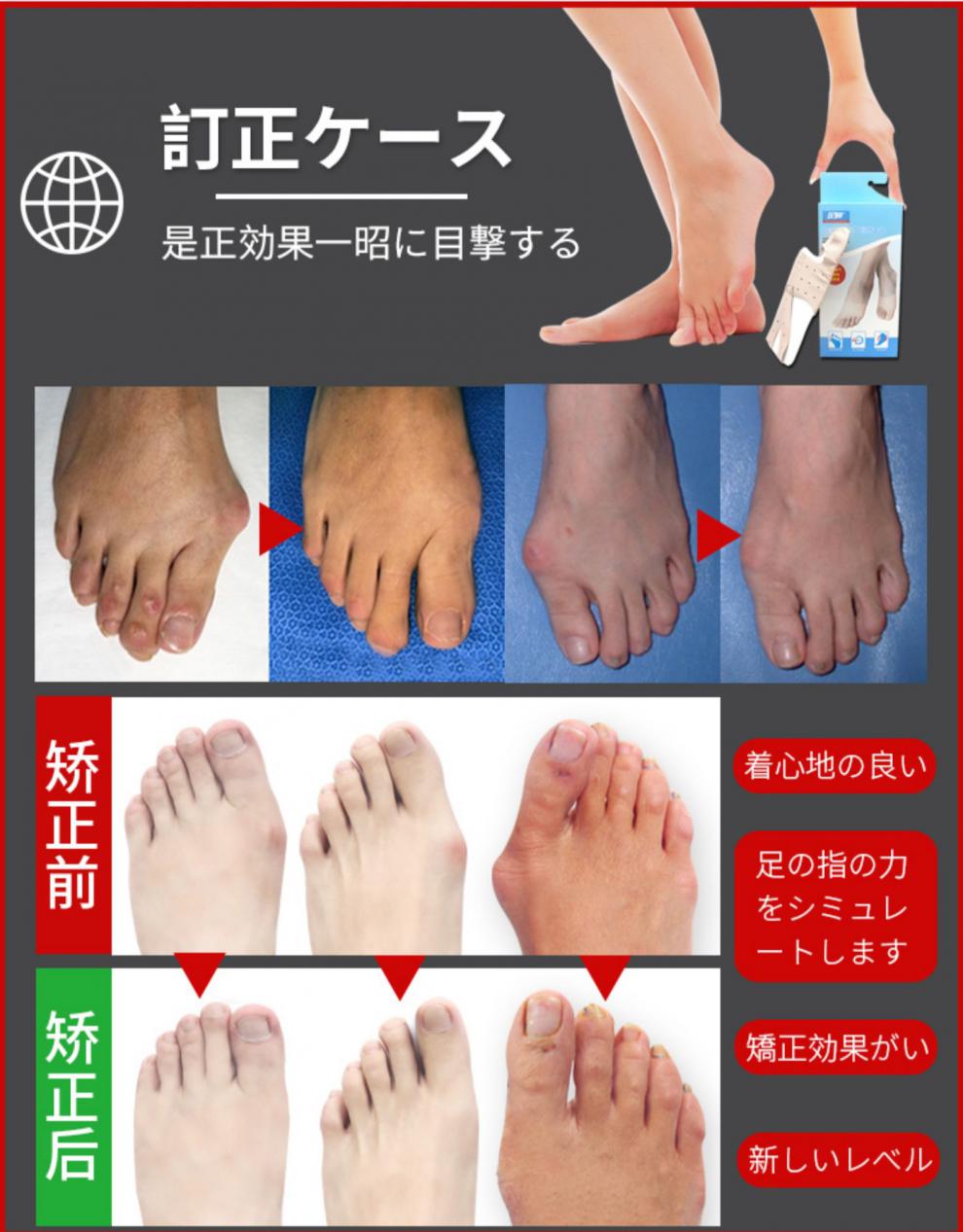 日本拇外翻脚趾矫正大拇指外翻矫正女大脚骨母趾头纠正分趾器 紫色