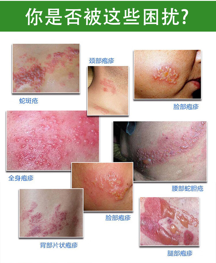 辉王e型胡克蛇精品火丹神经泡疹疼泡缠腰后遗症状