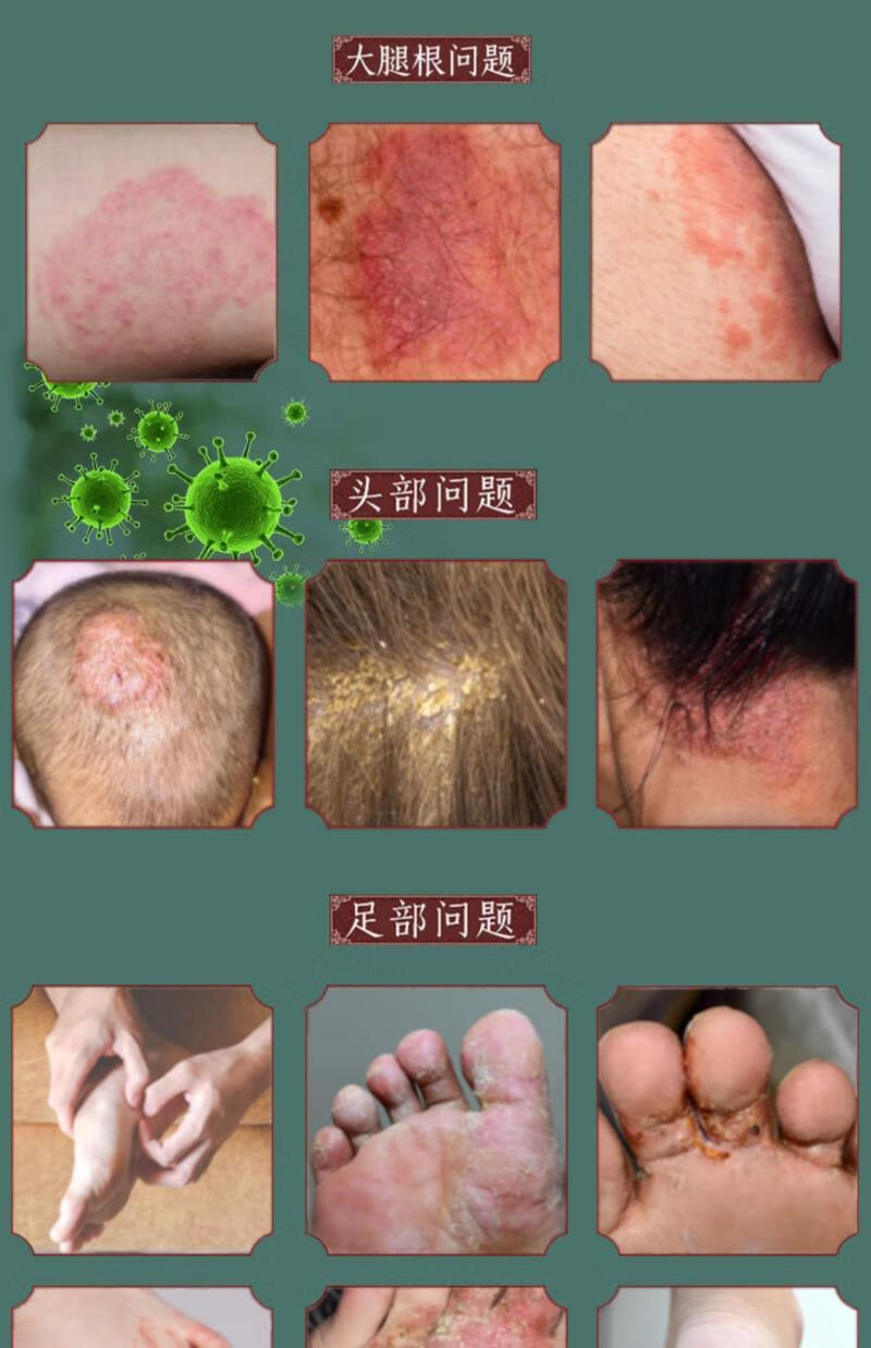 妙如莲百年虎毒膏25g手足过敏瘙痒皮肤湿毒 买2赠1 共发3盒【图片