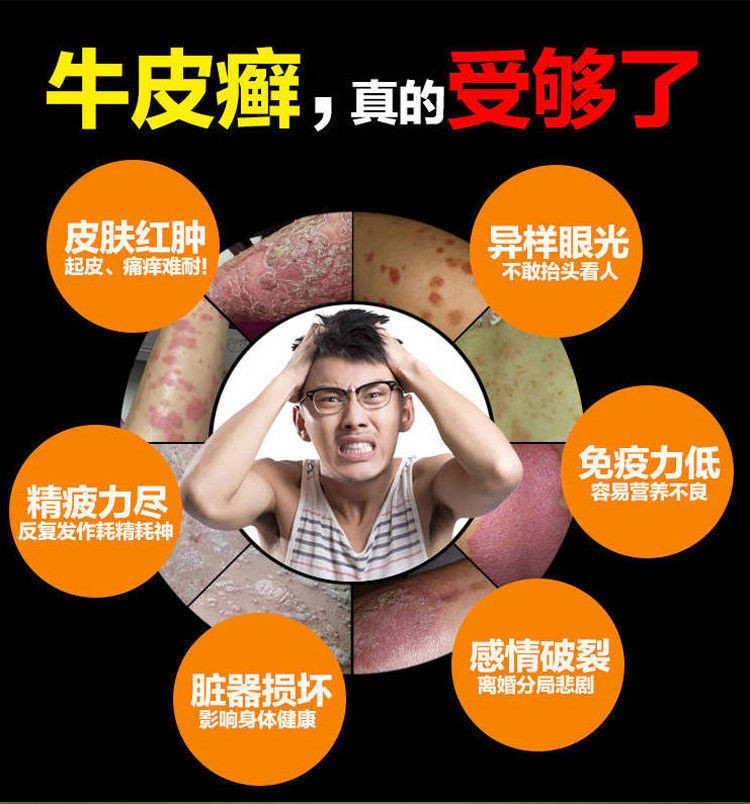 苗家老偏方皮癣牛专用皮肤癣痒灵瘙痒皮炎疹湿癣菌克星癣手足 1支试用