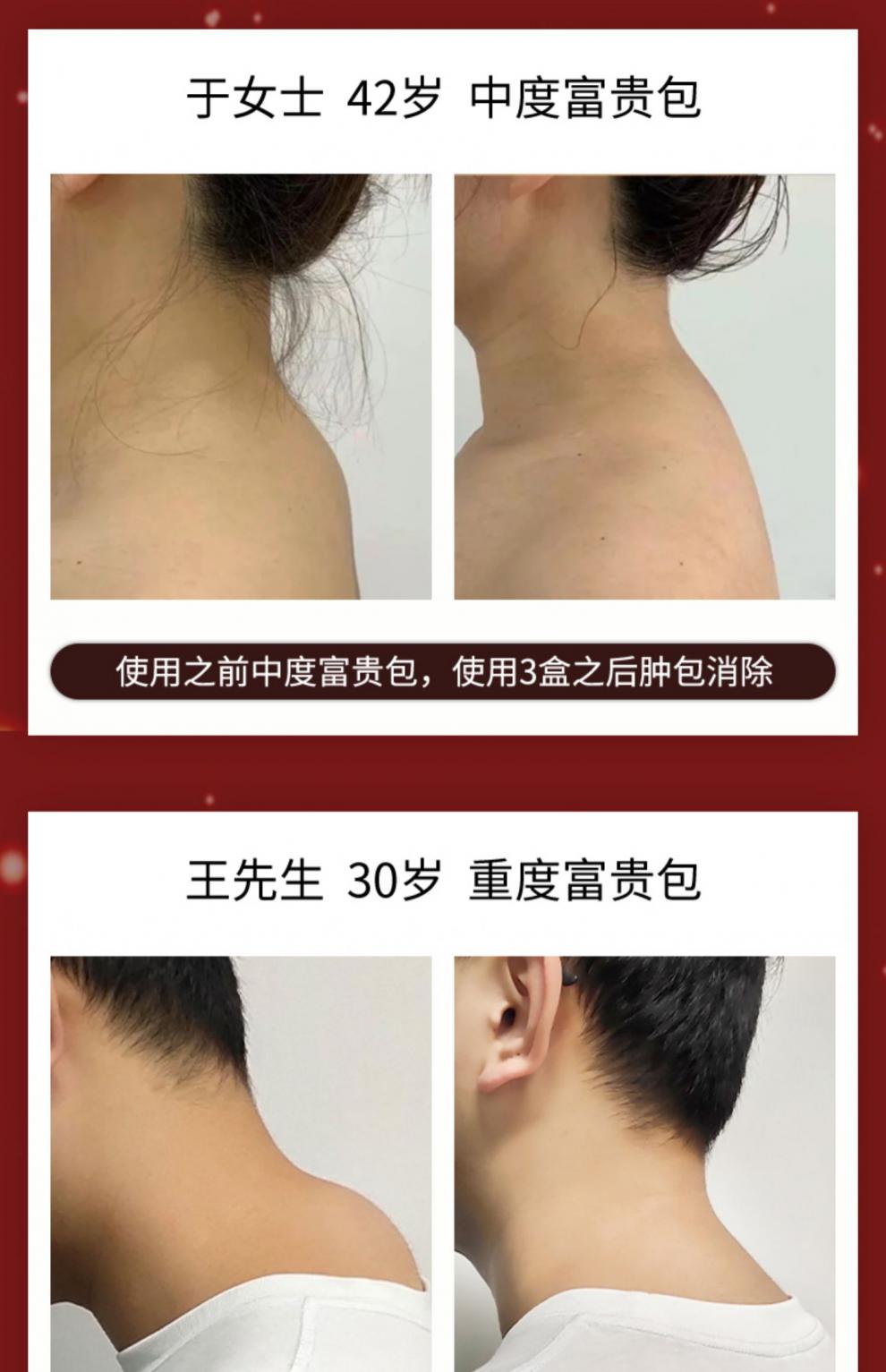 南京同仁堂富贵包贴学生老人缓解肩膀颈部颈椎疼痛官方