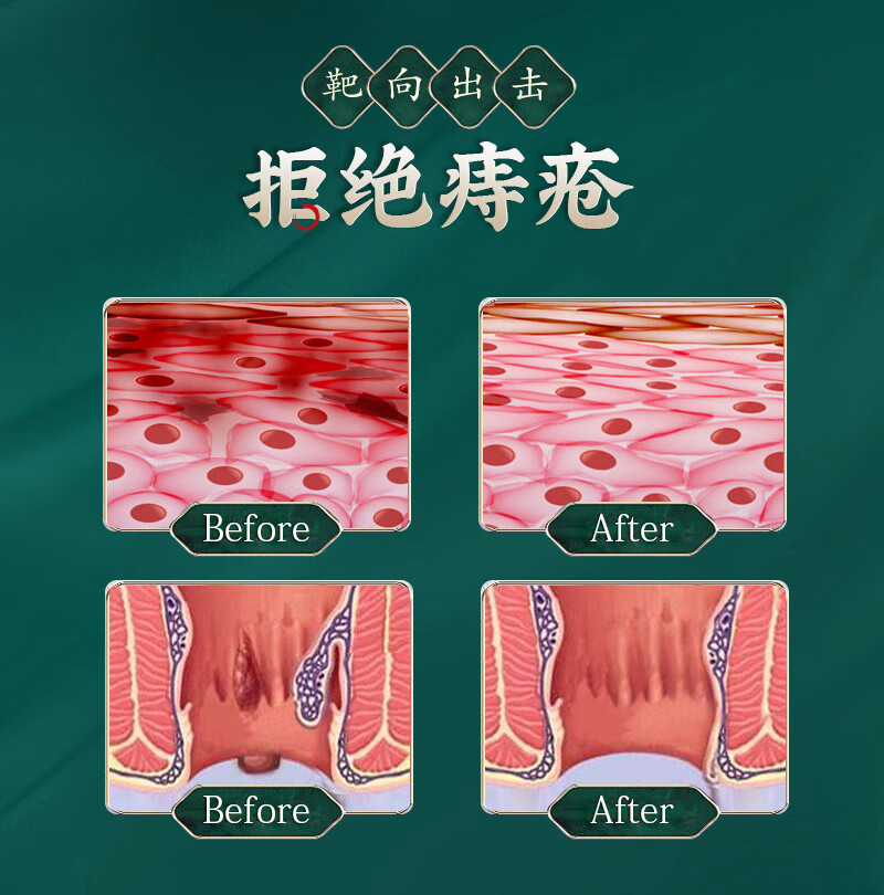 【药房直发】痔疮膏断痔膏内外混合痔出血温和护理膏痔疮栓现货 1盒装