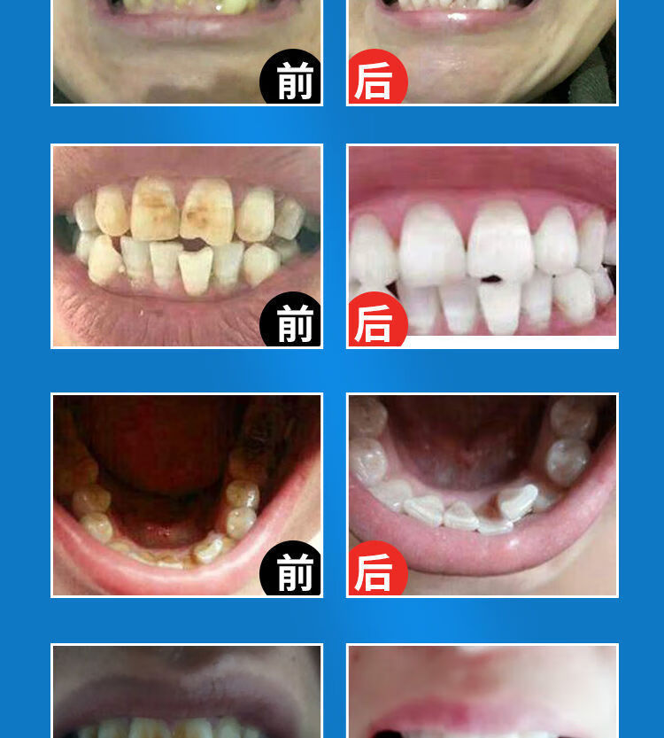 去黄牙烟渍茶渍牙垢牙斑净牙齿亮白脱色剂洗牙粉 【一瓶高效款 棉签