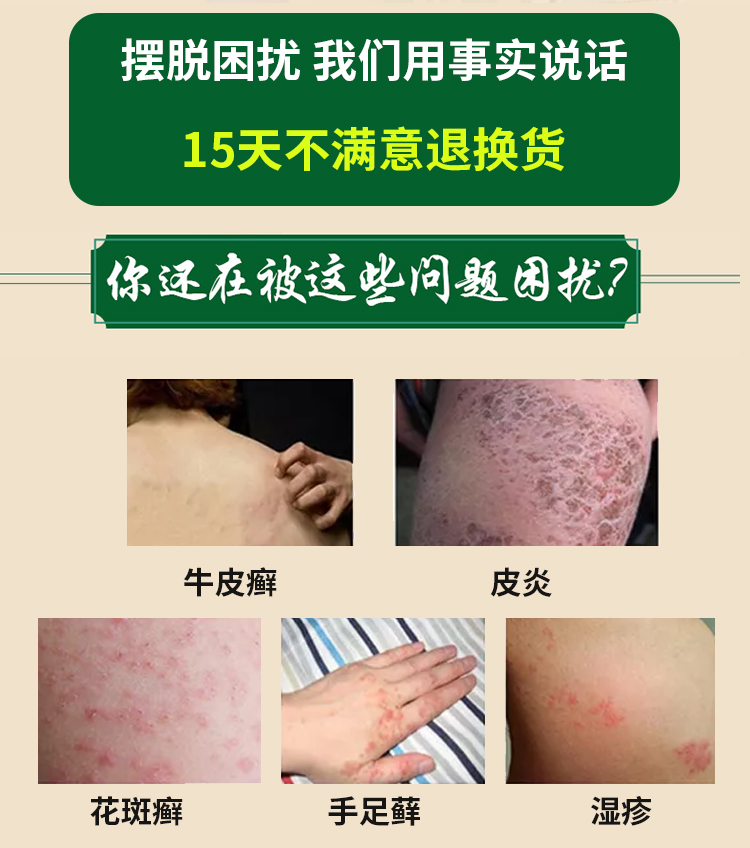 牛斗士软膏茂安牛斗士银鲜屑型湿痒脱屑掉皮头鲜i藓i股鲜i藓手足背部