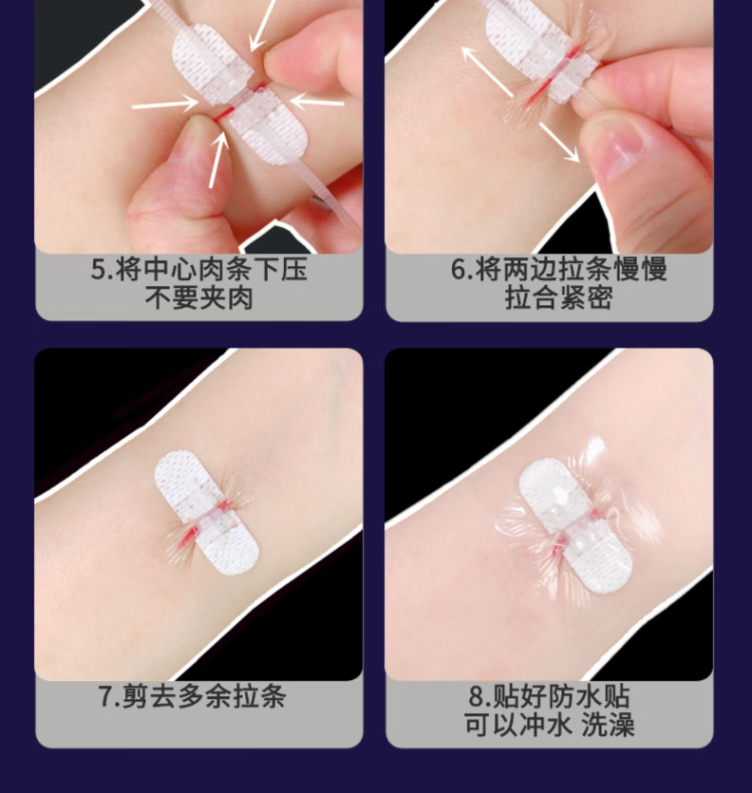 ja减张器免缝伤口贴减张贴缝合减张胶带拉合儿童手术疤痕zip进口