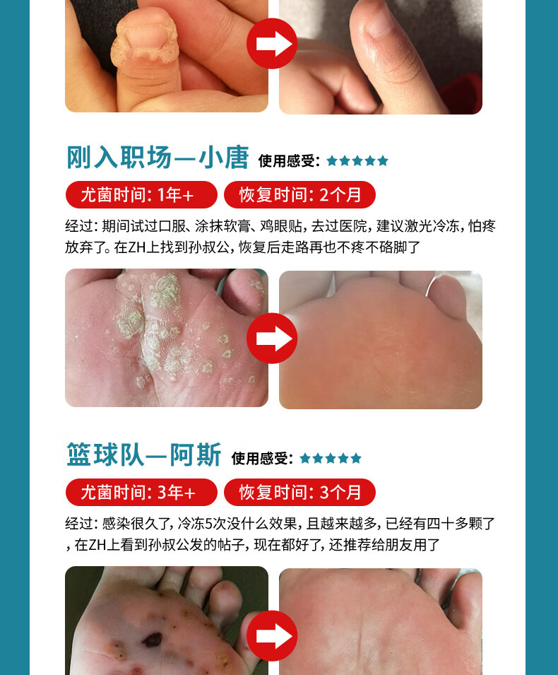 寻常优去除疣瘊跖尤脚底趾优病毒疣去优灵y膏马齿苋软膏甲周疣扁平尤