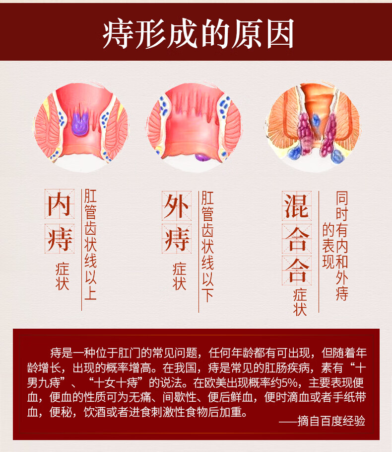 修正 痔疮膏肉球痔疮膏内痔外痔混合痔肛裂脓肿肛周抑菌乳膏壳聚糖