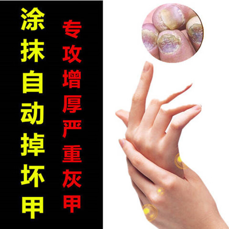 快速去除灰指甲脱钾精油玉指露5ml玉指露脱钾金油脱甲精油不修甲自动