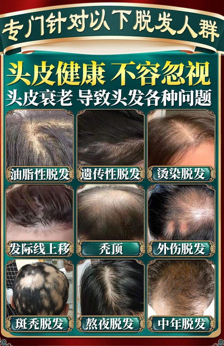 【官方旗舰】北朝首邦防脱育发液快速神器秃顶产后严重掉发头发快速