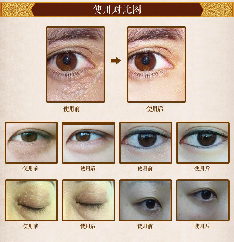 汗管瘤修复膏古方去脂肪粒眼霜消除油脂粒祛除眼部脸部脂肪粒膏男女外