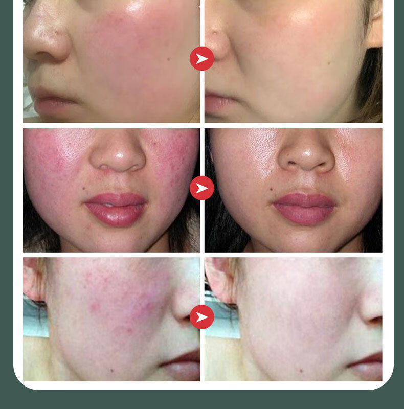 京品优选敏感肌修护霜起疙瘩红肿脱皮干痒急救脸过敏脸过敏修复乳植贝