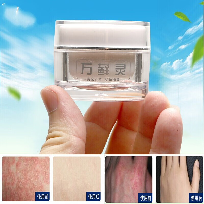 万藓灵癣膏外用软膏软膏大腿内侧 万藓灵一盒装【图片 价格 品牌 报价