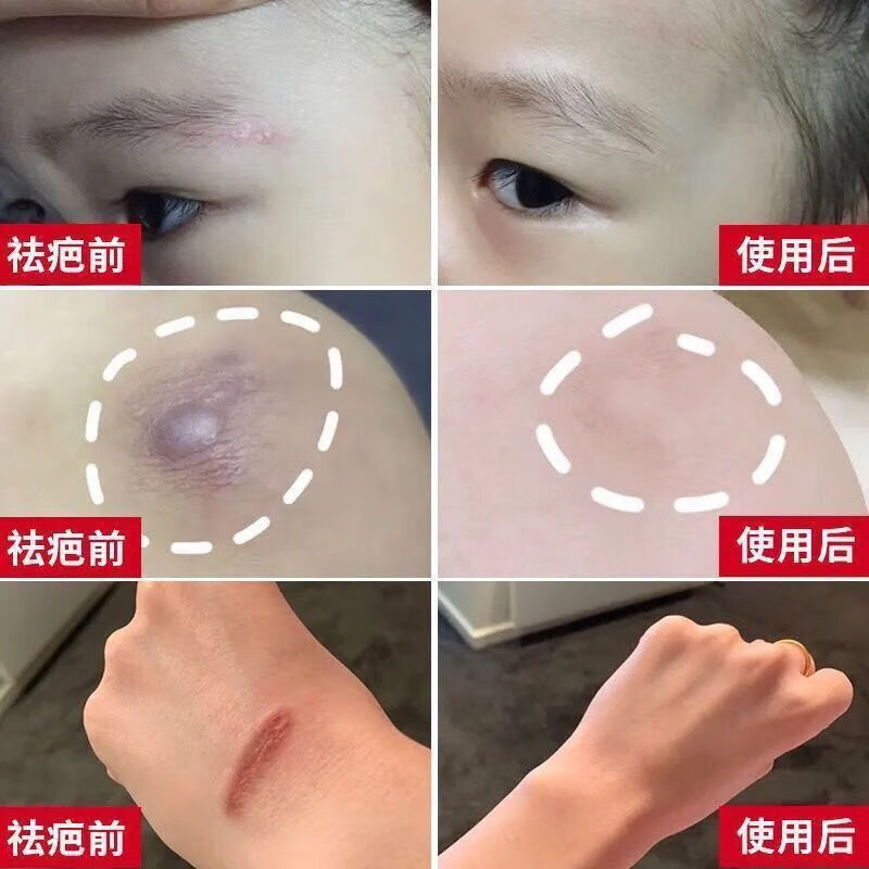 南京同l仁堂疤痕净护理伤痕软膏手术增生去凹凸祛疤膏疙瘩痘坑痘印假