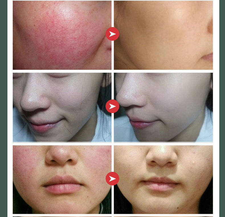 京品优选敏感肌修护霜起疙瘩红肿脱皮干痒急救脸过敏脸过敏修复乳植贝