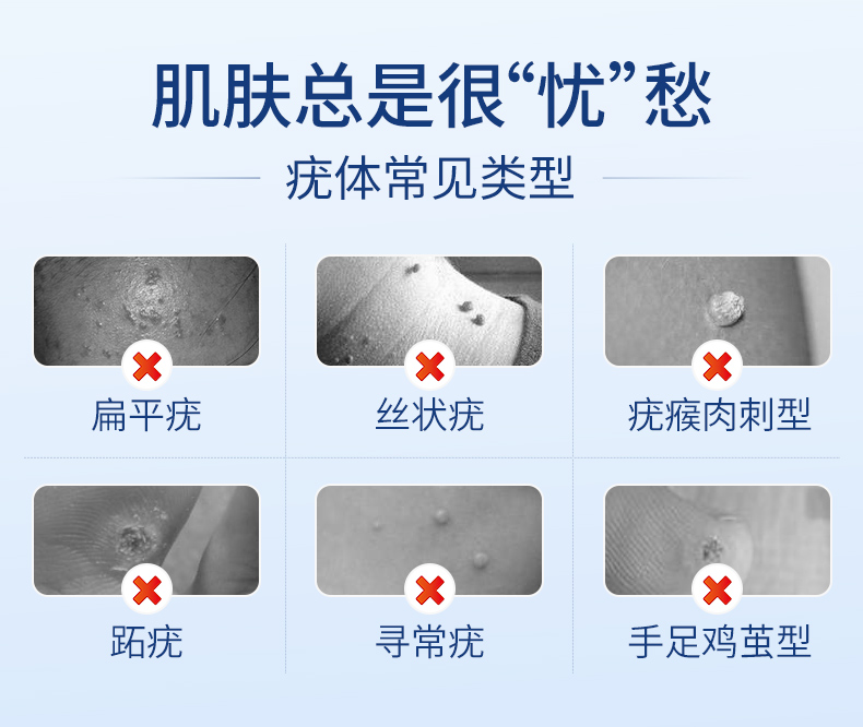 扁平疣日本去疣靈蹠疣尋常絲狀疣專用膏除面部瘊子肉刺全身大面積週期