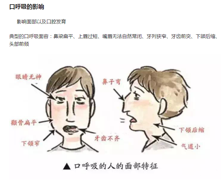 防睡觉张嘴儿童睡眠打呼噜止鼾带口呼吸矫正凸嘴流口水 纱纺款紫色 8