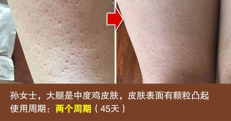 鸡皮肤上有红点变黑斑怎么回事(鸡皮肤上有红点变黑斑怎么回事啊)