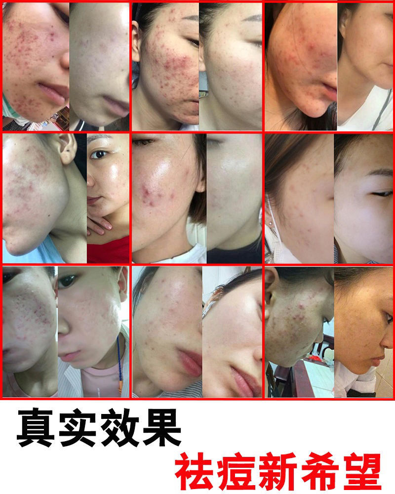 专营店正品推荐碧素堂贴脸式面膜隐形痘痘贴增白补水保湿睡眠面膜免洗