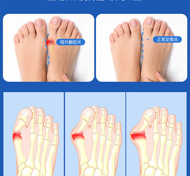 美輝拇指外翻腳趾矯正器糾正大拇指大腳骨腳趾重疊改善可穿鞋男女通用