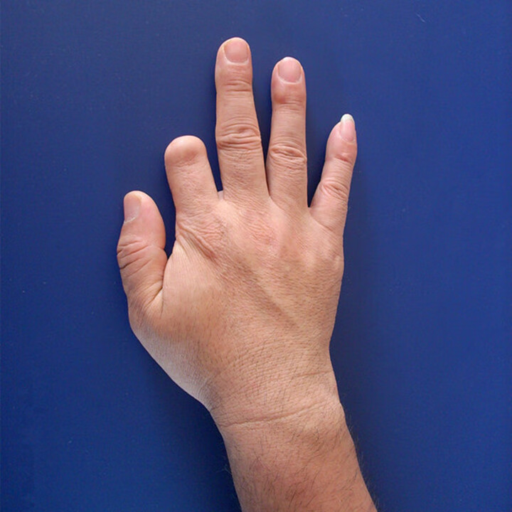 假肢手指假手指 指 断手指美容手指量身定做假脚趾假手指头 无名指