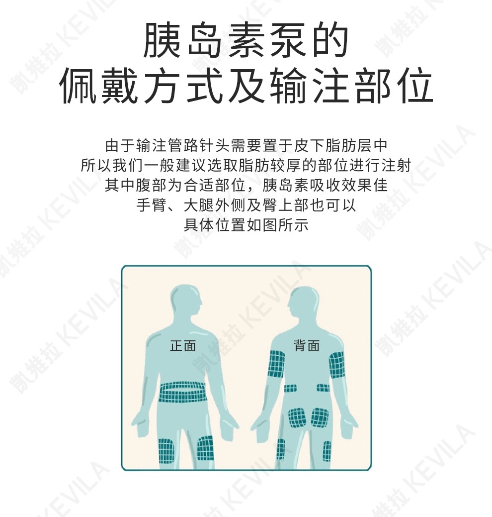 凯联innopump乐泵胰岛素泵智能蓝牙泵自动胰岛素注射泵快速接口钢针