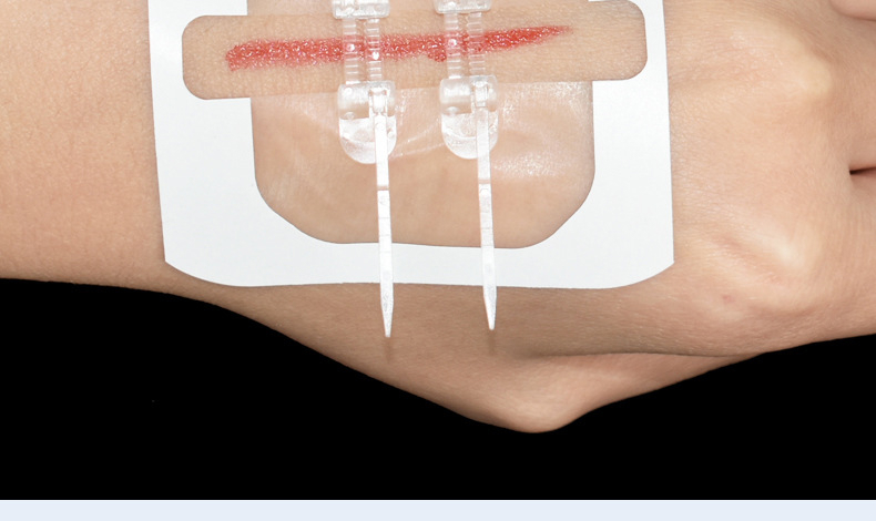 朗特拉链式创可贴减张贴伤口家用免缝合贴皮肤减张器弹性绷带 儿童款