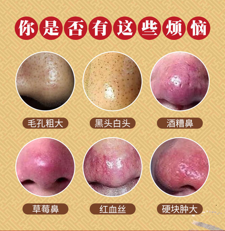 去酒糟鼻红鼻子草莓鼻修复鼻部l红血丝红鼻头酒渣l鼻毛孔男女 糜芳 发