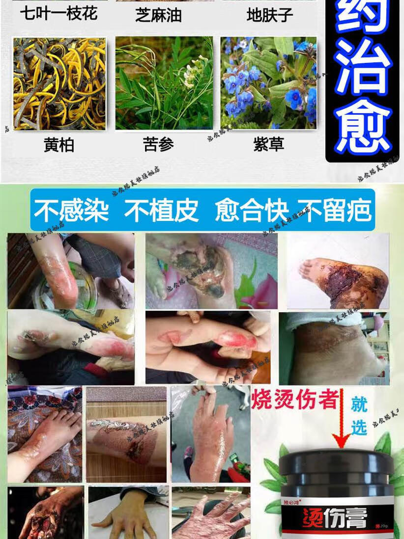 烫伤膏烧伤膏热油开水烫伤外用电焊烧伤创伤烫伤膏成人儿童修复膏轻者