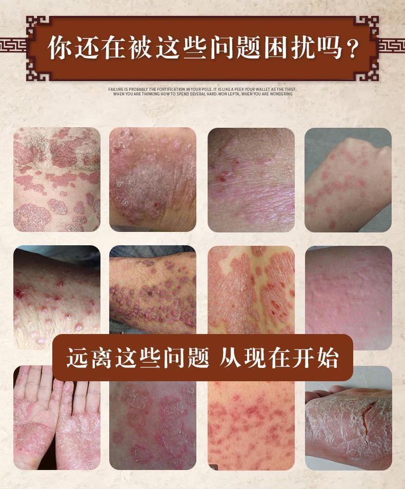 青霉素软膏湿毒清软膏抑真菌止痒尖锐瘙痒男性软膏肛痒舒外用 1支装 1