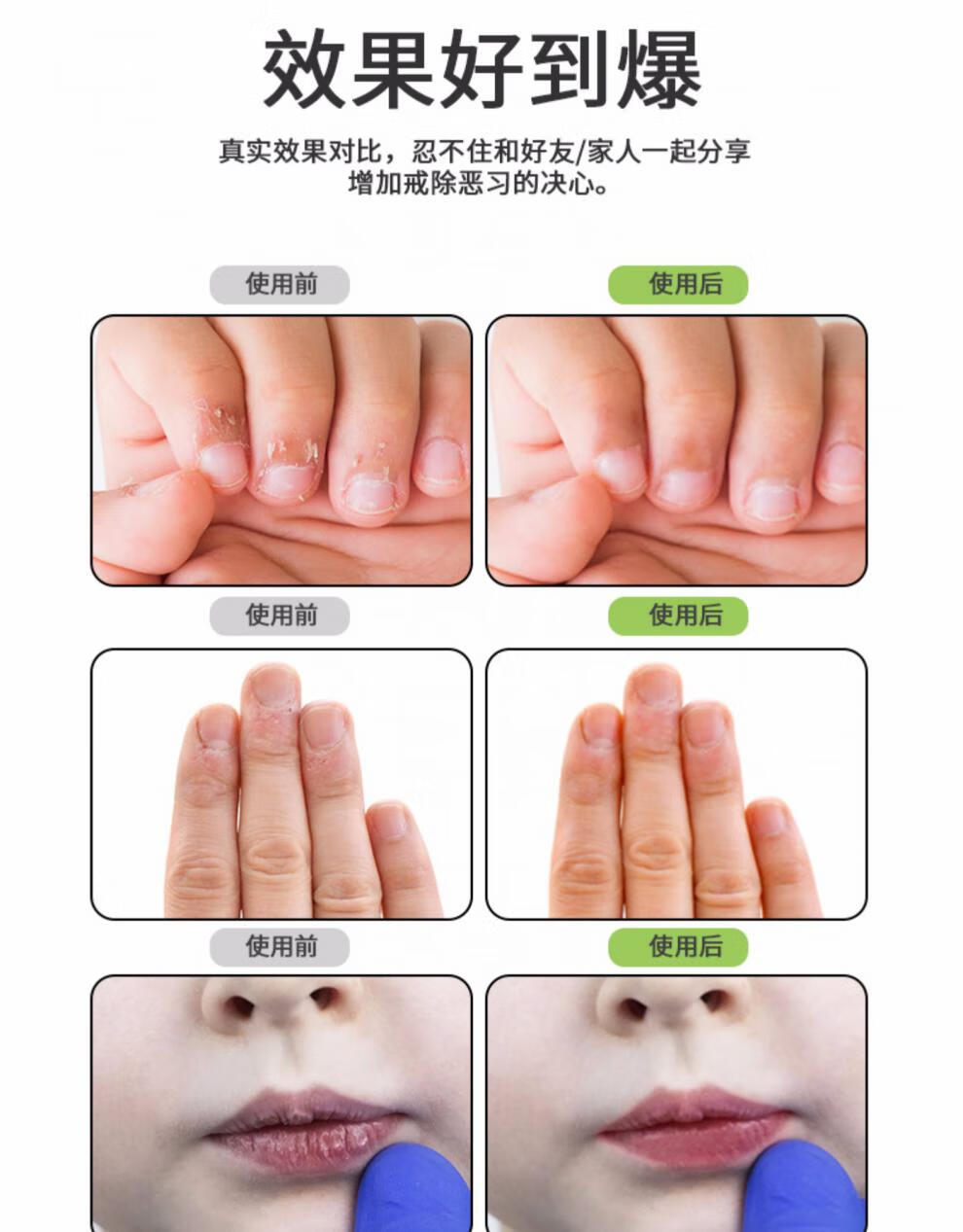 苦甲水儿童啃防咬指甲防止小孩神器戒手指吃纠正器宝宝苦水吃手药 1