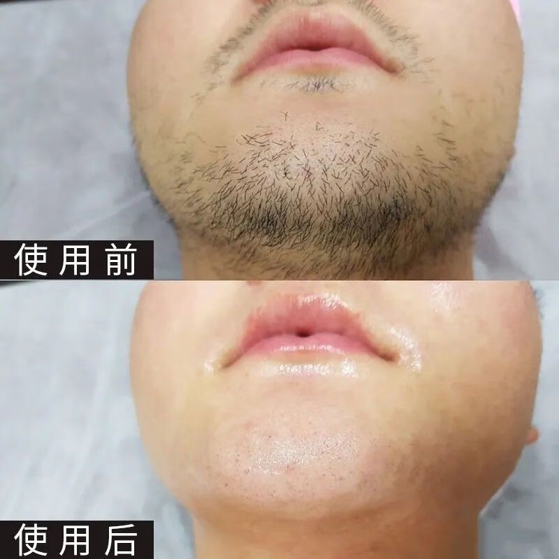 魅赞 胡子脱毛膏男士脸部专用去除胡须面部络腮胡学生党绝毛液全身去