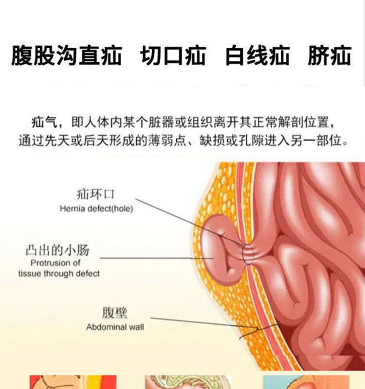 适用于疝气贴1贴消除中年人小儿腹股沟疝气小肠气脐疝斜疝肿买三盒带