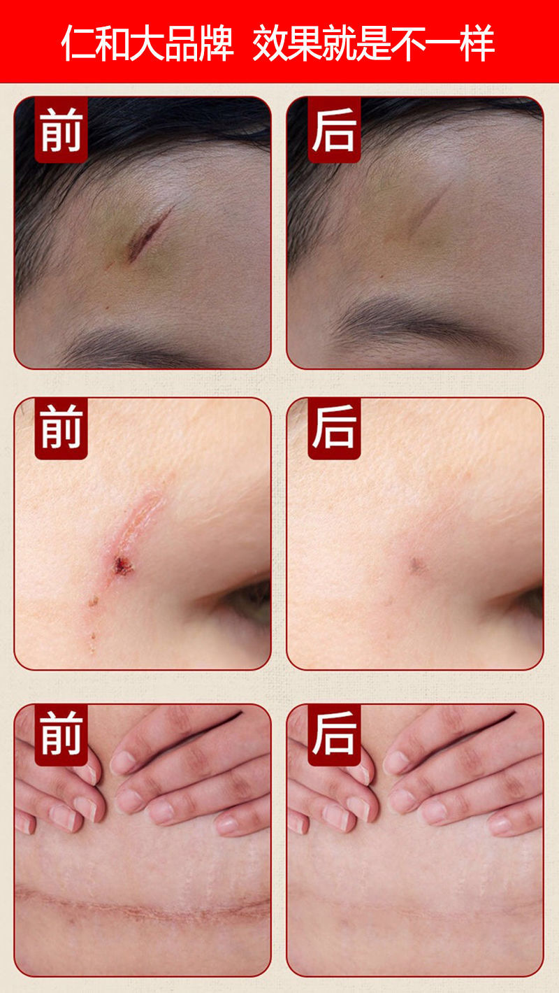 仁和硅酮疤痕凝胶护理修复去疤膏剖腹产增生烧烫伤妊娠妏脸上 一支