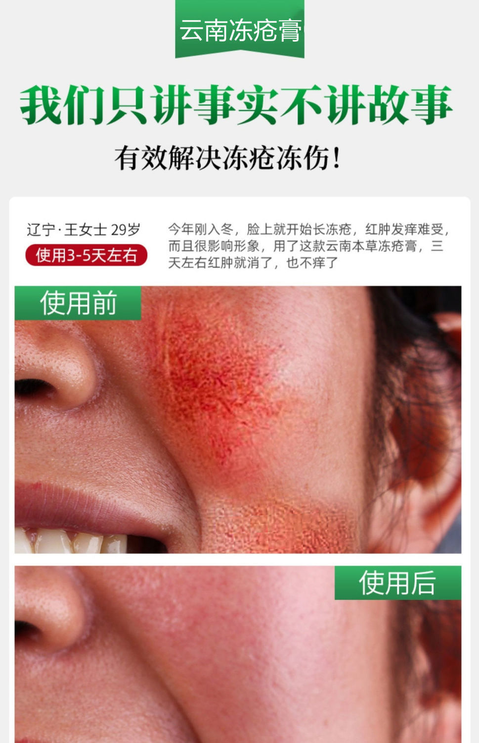 冻i疮膏防冻止痒冻伤学生老人手后跟脸部耳朵开裂冻伤膏 一盒基础装