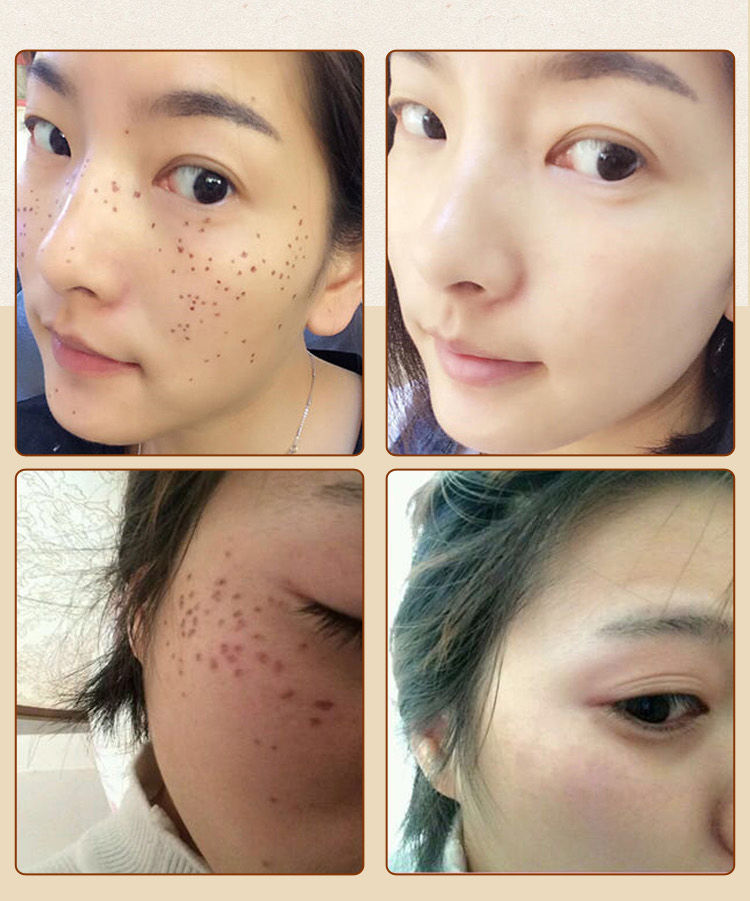 面部护肤 其它面部护肤 悦薇娅(reviya) 去痣点痣药水无痕黑痣祛痣斑