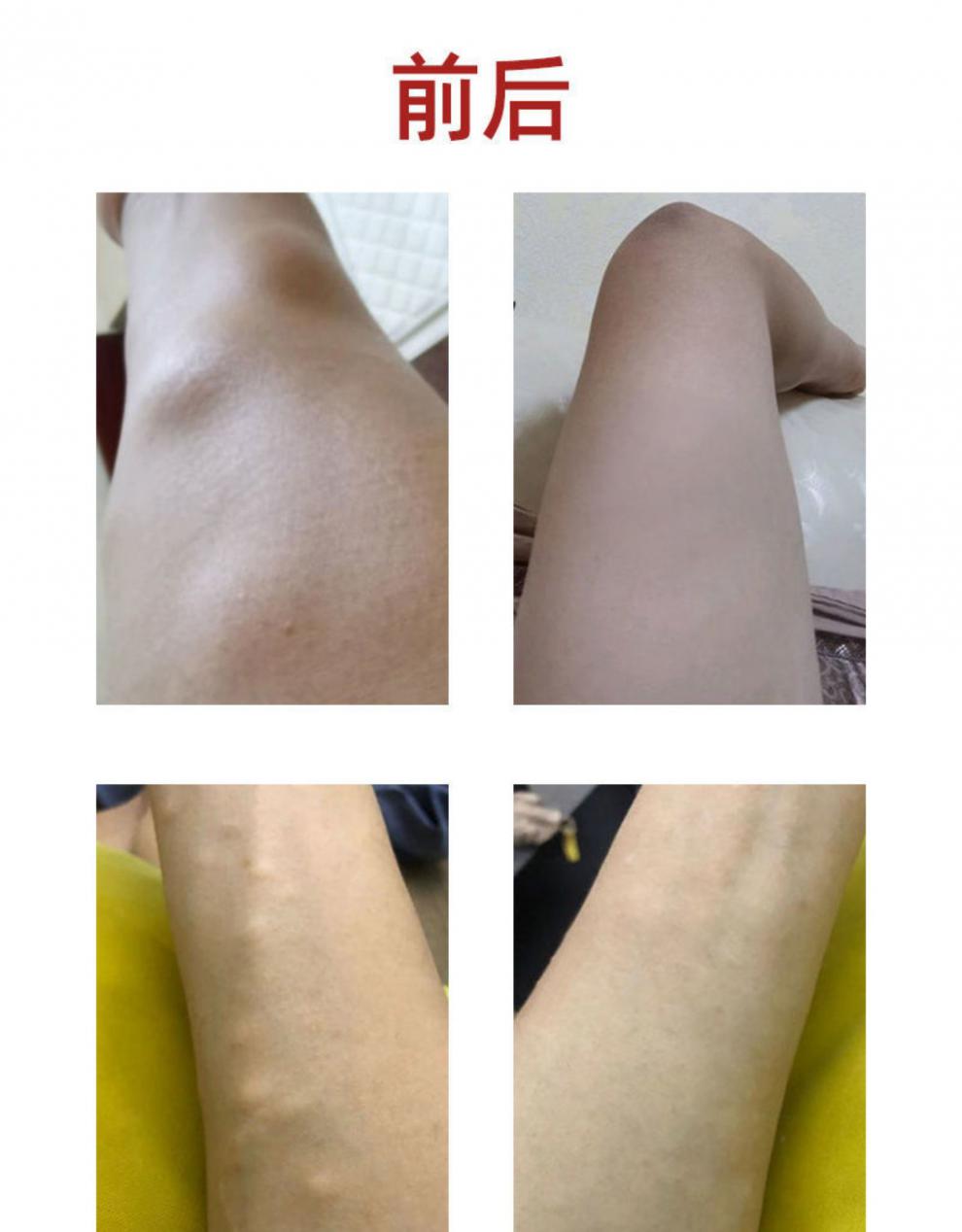 认准商标a型悦能官方脂肪瘤贴皮下肿块贴a型悦能买32五盒装