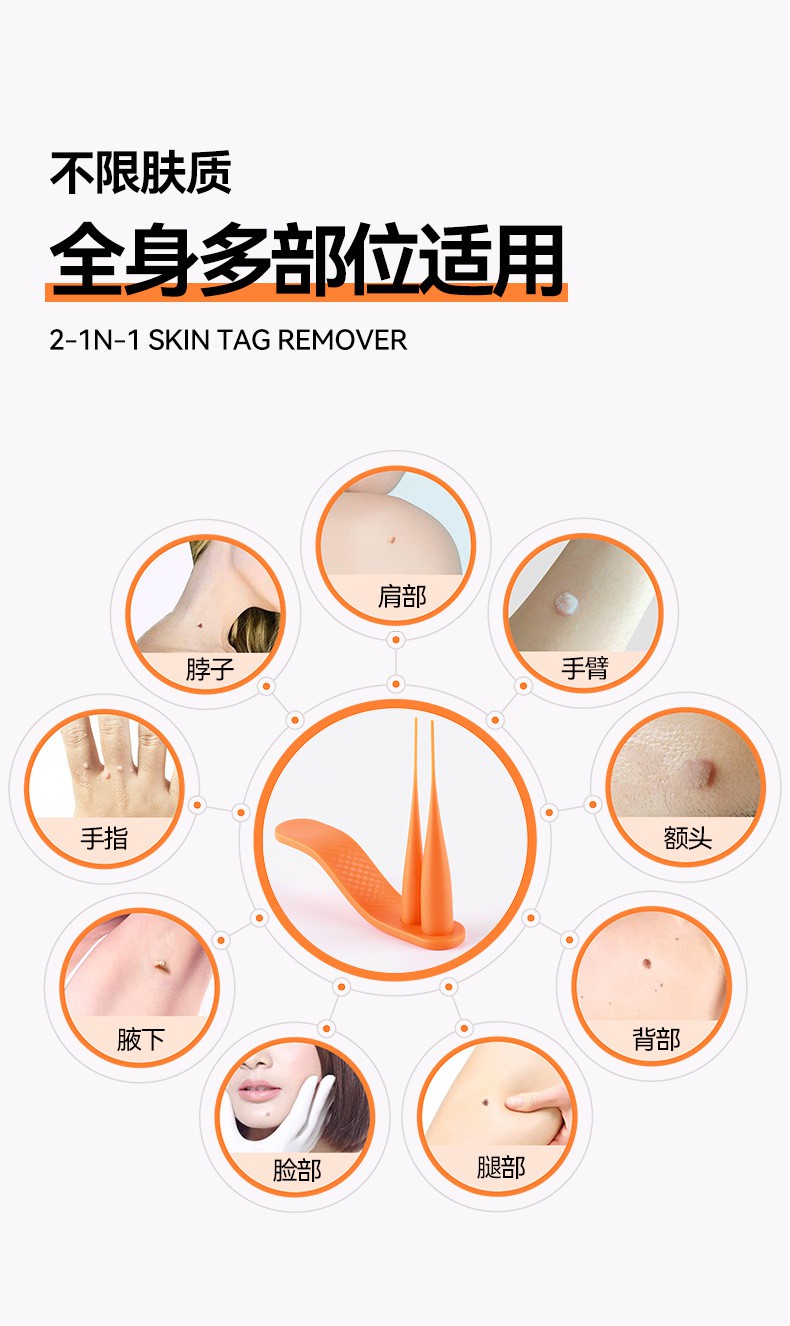 去除脖子上长的瘊子小肉粒疙瘩专用肉痣肉刺祛疣体丝状疣皮赘