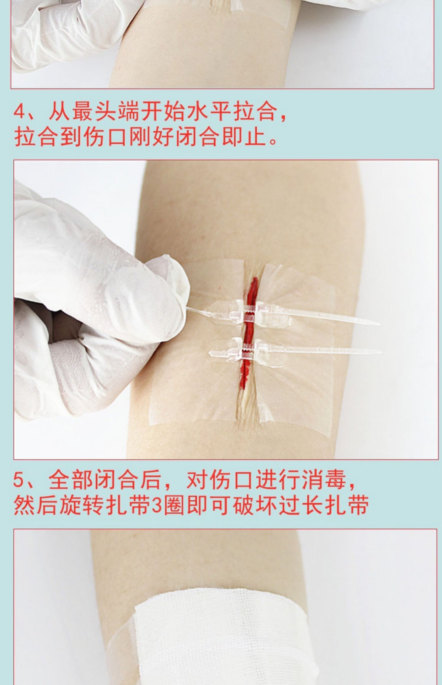 朗特皮肤减张器术后伤口缝合器拉链式创口贴免缝针皮肤吻合器nc3盒6片