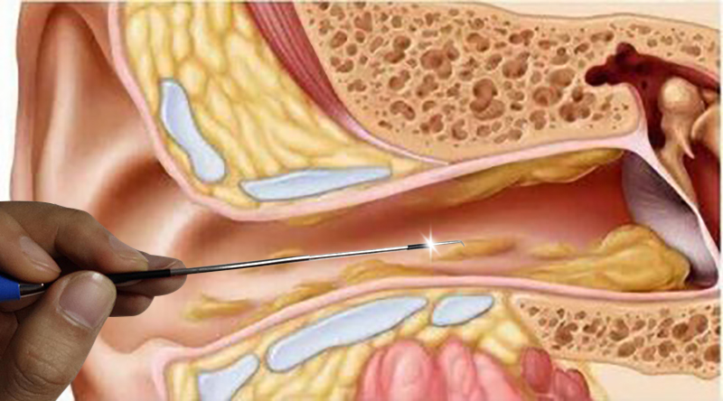 阿昌头部发光耳钩usb充电采耳工具耳结石硬耳屎软化耵聍栓塞挖耳神器