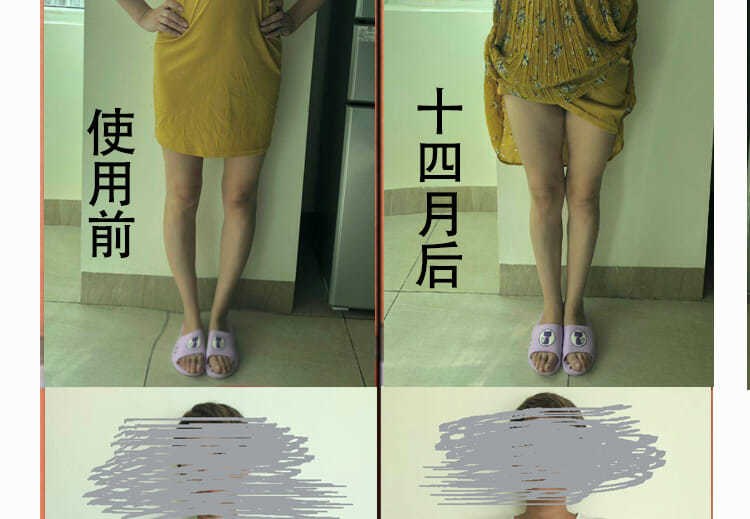 o型腿矫正鞋垫矫正腿型直腿内八小腿足外翻ox型腿x型腿矫正器 【第