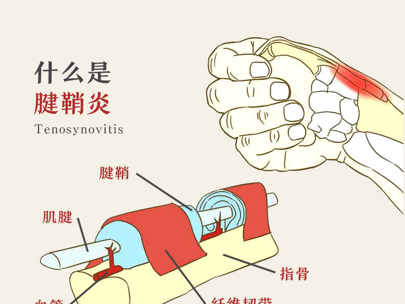 腱鞘炎症状治疗方法图片