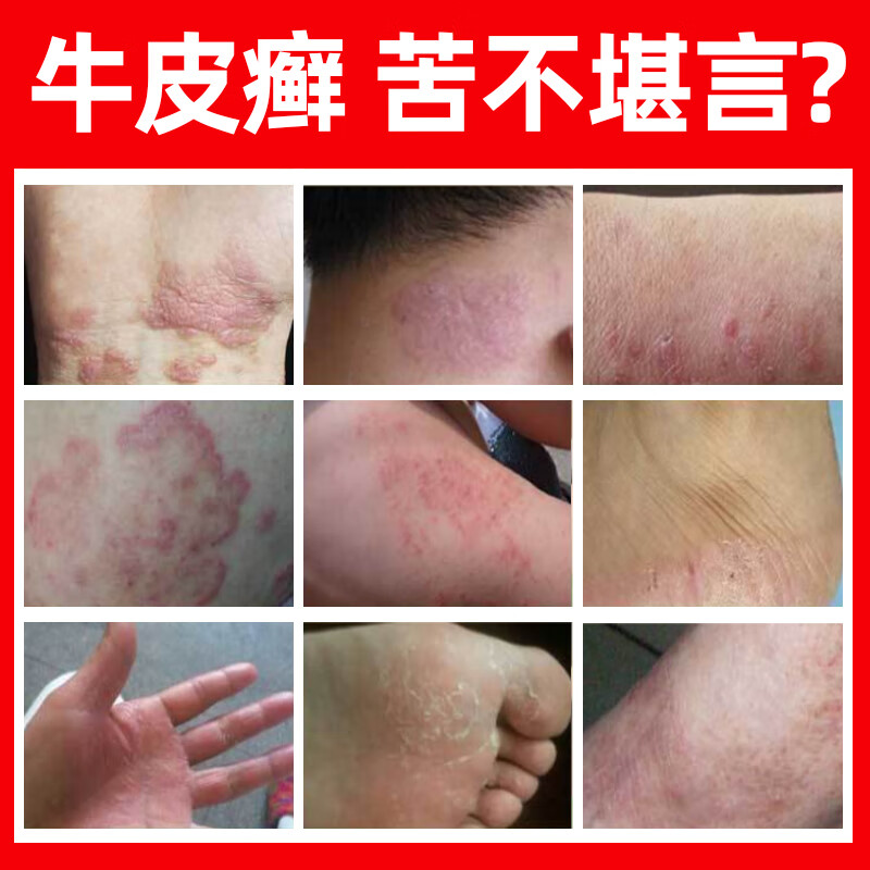 华北制药癣毒清膏顽固银屑牛皮藓癣手足癣冷敷凝胶3盒拍下发5盒大面积